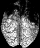 Venous infarcts, frontal lobes bilaterally, dorsal view